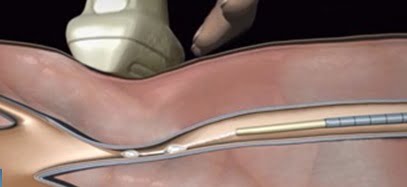 Medical Superglue - Vein Doctors Group